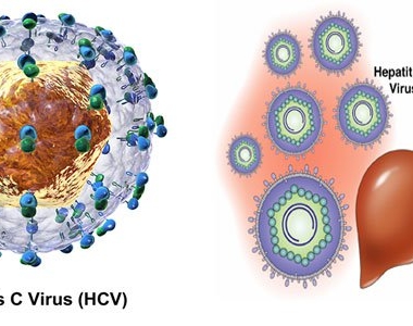 BỆNH VIÊM GAN DO VIRUS, TRIỆU CHỨNG, CÁCH CHĂM SÓC VÀ PHÒNG NGỪA